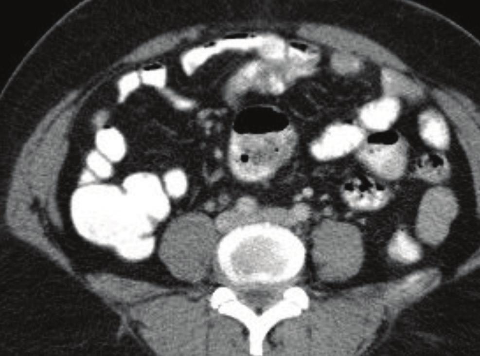 abnormalities, bowel dilatation and adjacent loculated fluid collections.