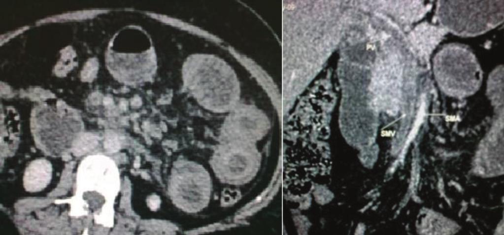 Figure-4 (a, b): (a)axial contrast enhancend CT image showing symmetrical wall thickening of ileal loops with target sign (b) Coronal venous phase CT images showing thrombosis in superior mesenteric