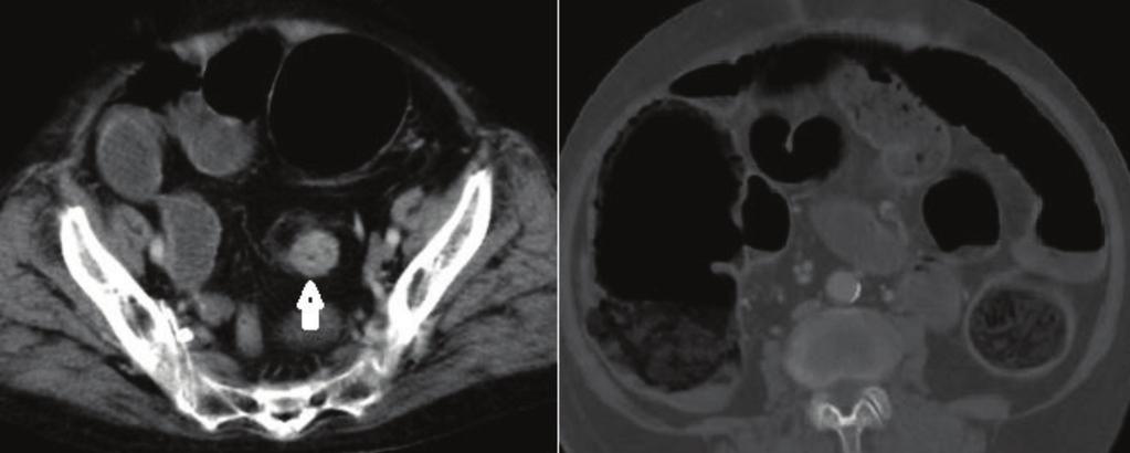Figure-5 (a, b): Axial contrast enhanced CT images (a) showing symmetrical circumferential wall thickening of sigmoid colon (arrow) causing severe stricture and (b) showing obstruction of proximal