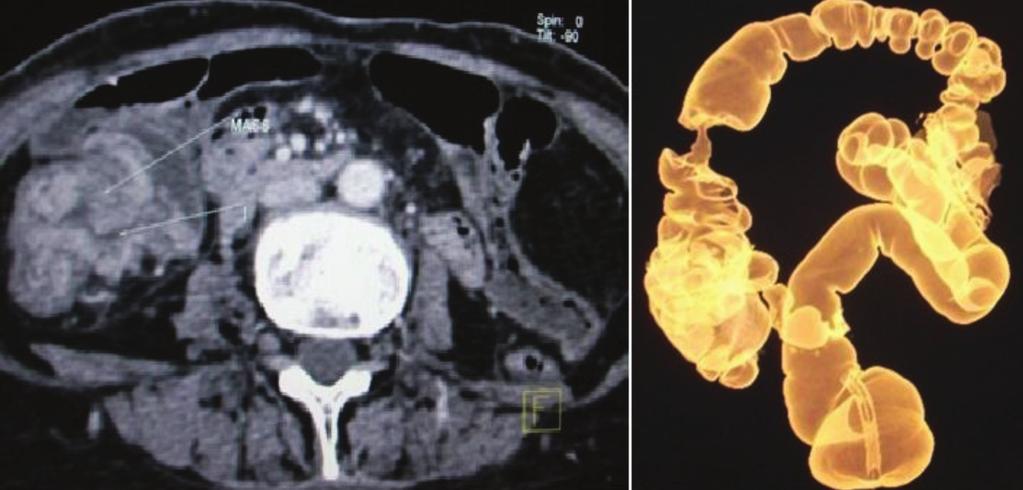 (b) 3D virtual volume rendered image of CT colonography showing short segment irregular lesion with shouldering at either ends and causing stricture. Colorectal malignancy is most common (82.