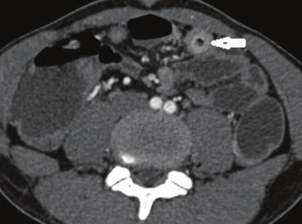 Figure-7 (a, b): Contrast enhanced coronal CT image showing long segment wall thickening of ascending colon and caecum (arrow).