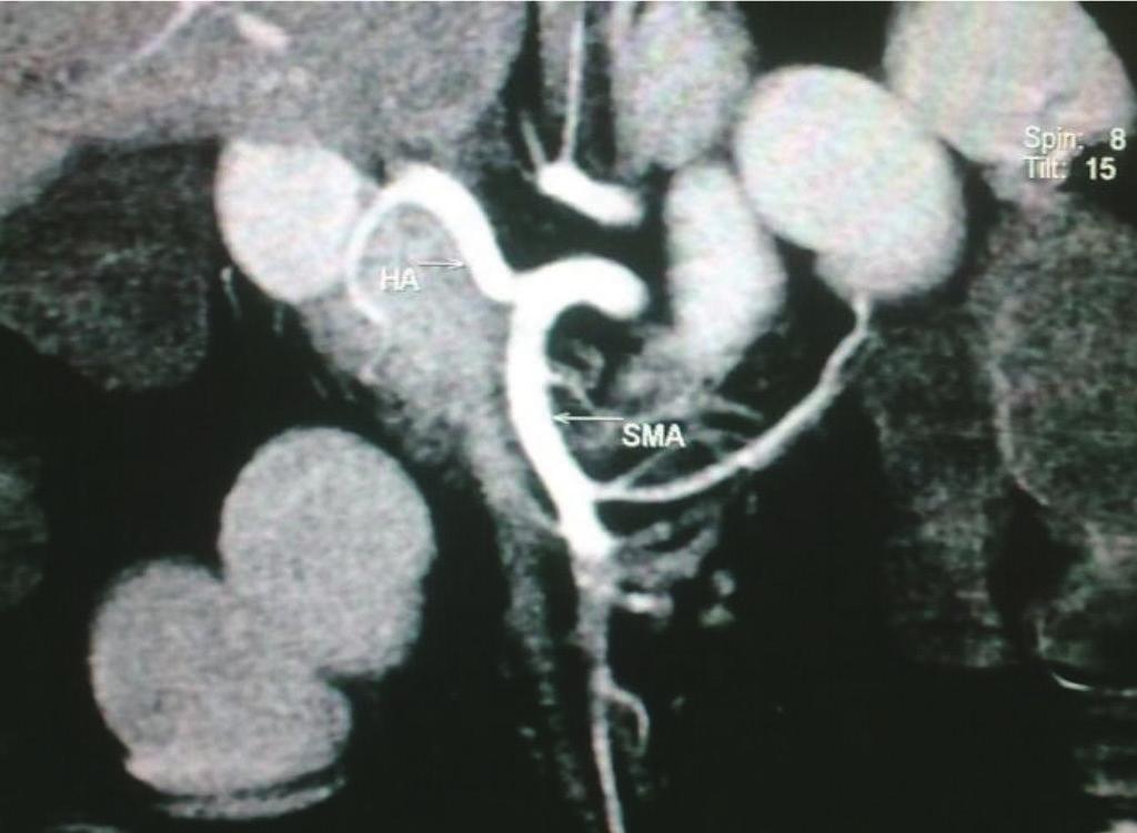 Crohn disease Figure-8: Axial contrast enhanced CT scan image showing Halo sign (arrow) - Crohn s disease.