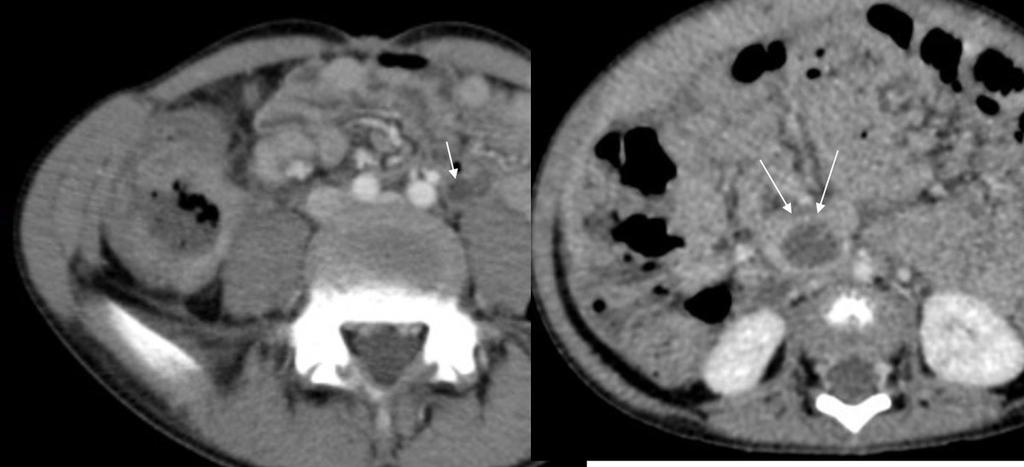 Fig. 4: Malignant tumors: axial and coronal enhanced CT scans shows a asymmetric thickening of the cecum (large arrow) and a mesenteric lymph nodes (arrow) Fig.