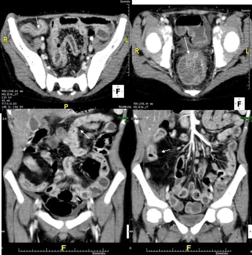 Fig. 6: Crohn's disease: two axial and two coronal enhanced CT scans shows the discontinuous involvement of the bowel (colon and ileum bowel;