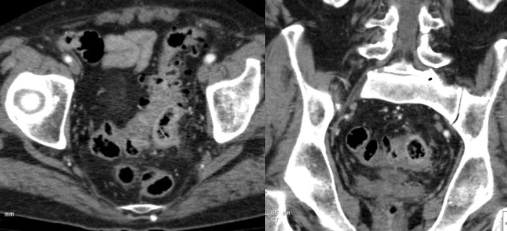 Fig. 7: Diverticulitis: axial and coronal enhanced CT scan show Symmetric focal thickening of