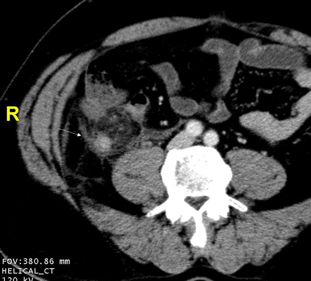 Fig. 9: Retro cecal acute appendicitis : dilated appendix,