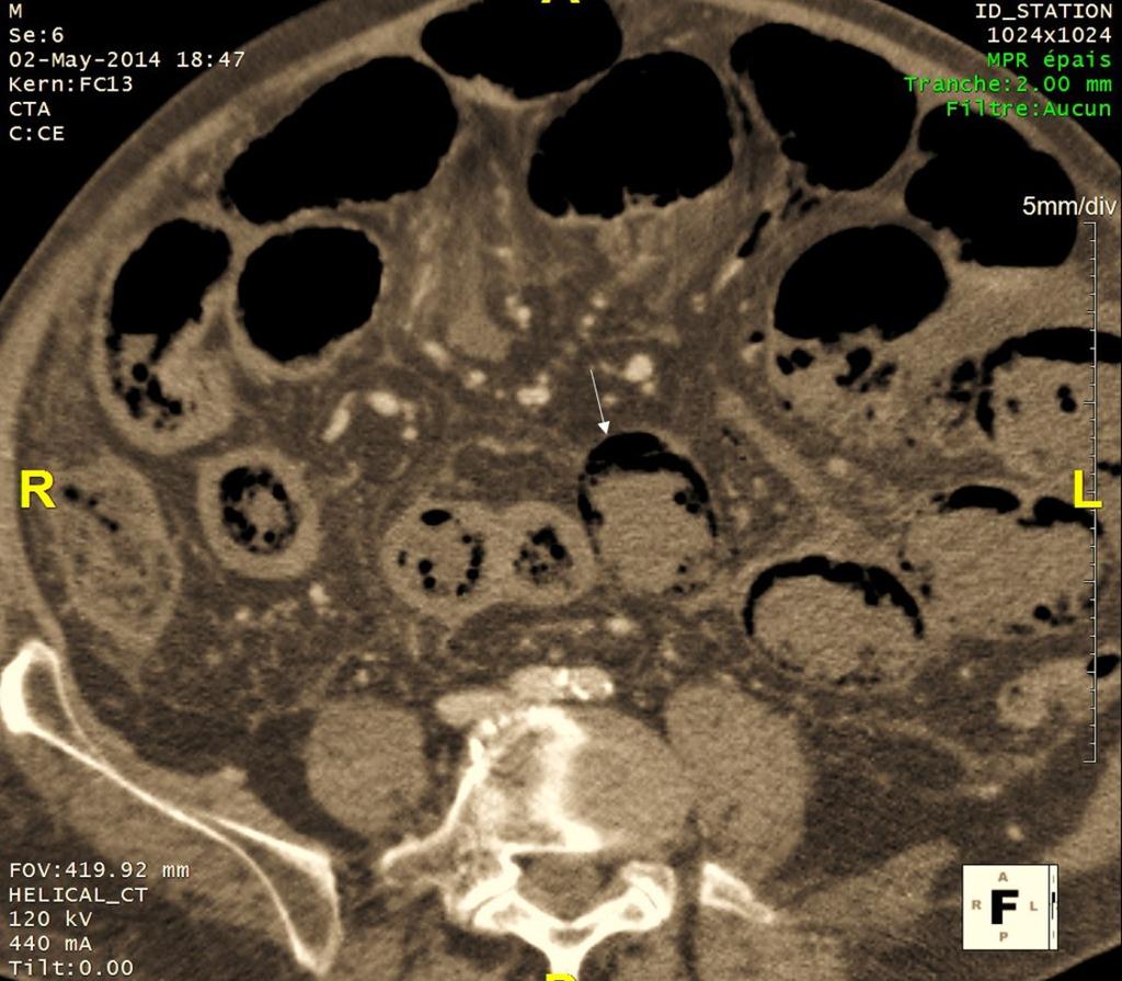Fig. 12: Bowel ischaemia: thin bowel
