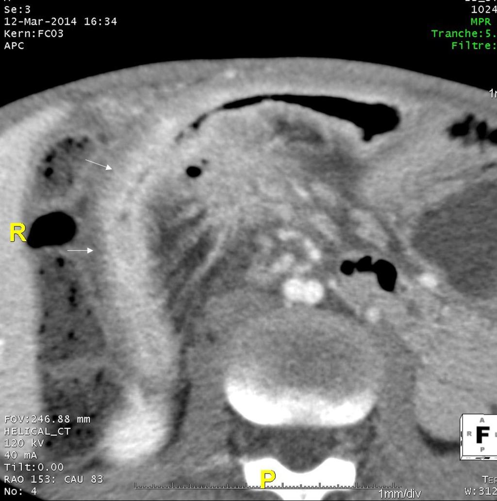 Fig. 15: Stratified bowel wall thekning (arrow)