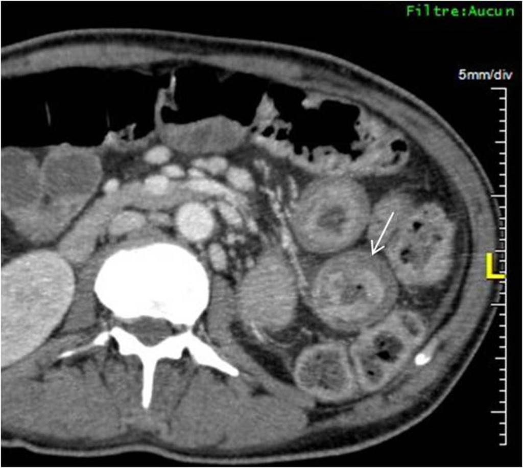 Fig. 19: Inflammation of small bowel due to