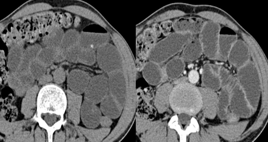 Fig. 3: Enteroclysis, axial CT: before