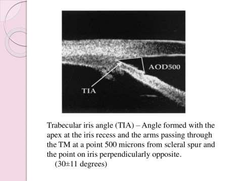 Trabecular-iris angle (θ1): The angle formed with the apex at the iris recess, and the arms passing through