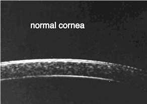The Cornea: The superficial location of the cornea permits the use of higher frequency transducers.