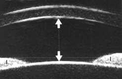 The corneoscleral junction and scleral spur can be distinguished consistently with ultrasound biomicroscopy.