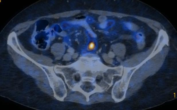 PET image reconstruction The goal of PET/CT imaging: Detect harmful things that might otherwise be unnoticed.