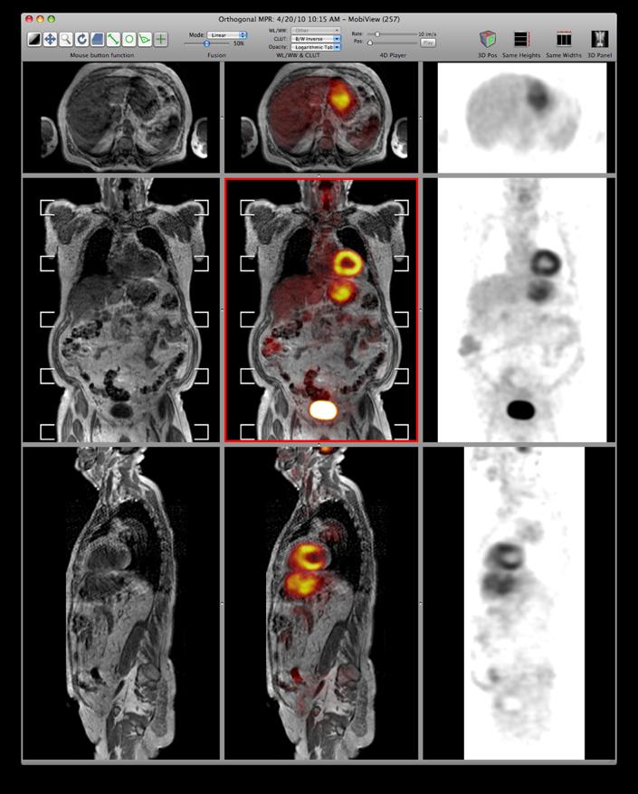 PET-MRI in Geneva Resullts SUV measurements performed on two