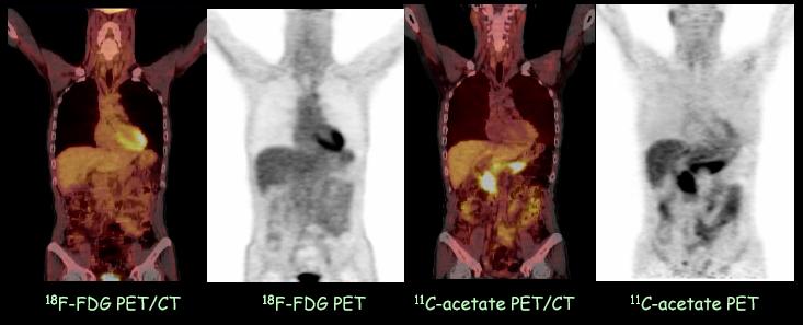 New tracers in PET imaging C11 - ACETATE Applications: - Hepatocellular