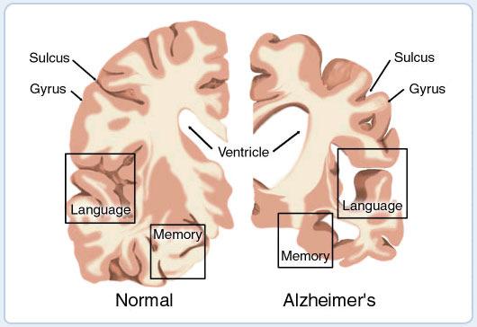 Degenerative Disorders Alzheimer's disease Parkinson s disease Huntington s disease Pick s