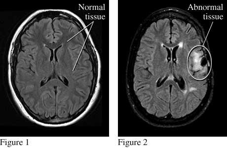 Traumatic Brain Injury Closed or open head injury Chronic Traumatic Encephalopathy (CTE)