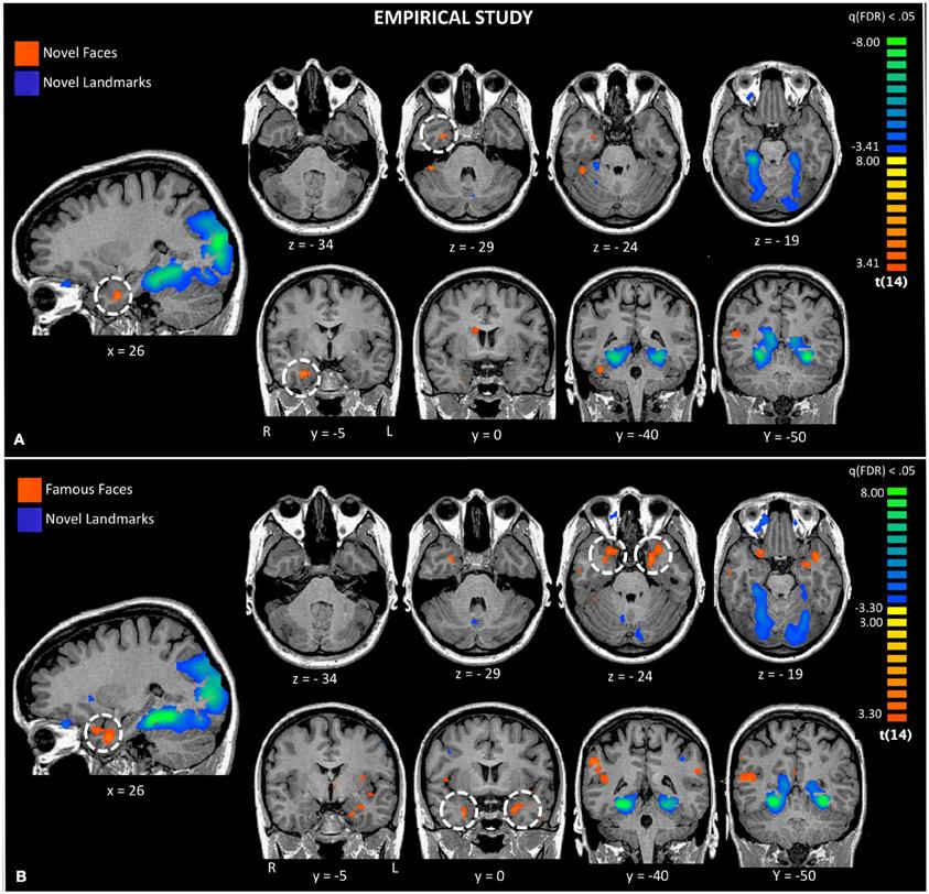 onset Neuroimaging MRI vs.