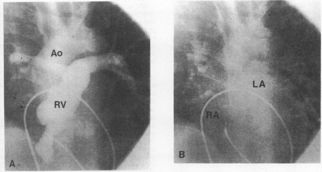 348 Fig. 3(A) A selectedframe from the right ventricular cineangiogram obtained in afour chamber view (45 left anterior oblique with 350cranial angulation).