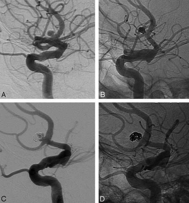 Fig 1. A 3-mm ruptured anterior communicating artery aneurysm in a 58-year-old woman. A and B, Small aneurysm before (A) and after (B ) coiling.