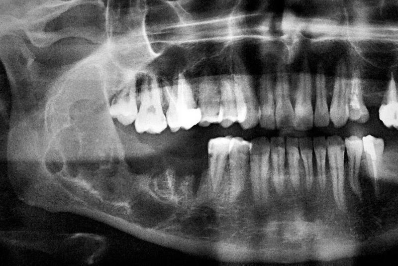 DIFFERENTIAL DIAGNOSIS OF RADICULAR CYSTS Ameloblastoma Most common type of odontogenic tumour May grow without complaints Migration of teeth, asymetric swelling of the jaw, facial