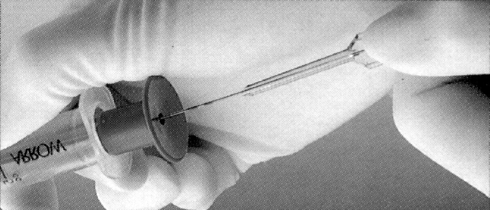 Insert the fluid primed blunt tip transduction probe into the rear of the plunger and through the valves of the Raulerson Syringe.