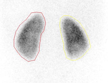 DMSA scintigraphy : the pro * High signal to noise ratio * The best tool