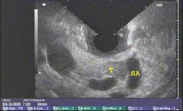 duodenal, rectal wall Wireless small bowel capsule endoscopy May