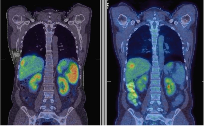 HEPATIC METASTASES IN THE SAME PATIENT Hepatic metastases from NET (68Ga-octreotate PET, left) Colorectal cancer (FDG-PET, right) in the same patient Image courtesy of Dr. Christos G.