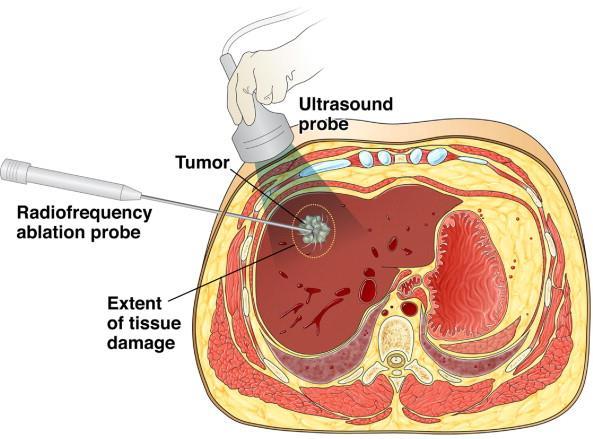 OTHER ABLATION THERAPIES Radio-frequency ablation Laser-induced