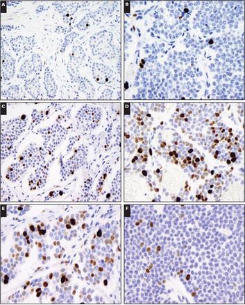 NET HETEROGENEITY Intra-tumoural phenotypic heterogeneity is frequently observed in GEP-NETs Most primary small bowel NETs are G1 tumours (Ki67<2%) However, when these tumours metastasize to the