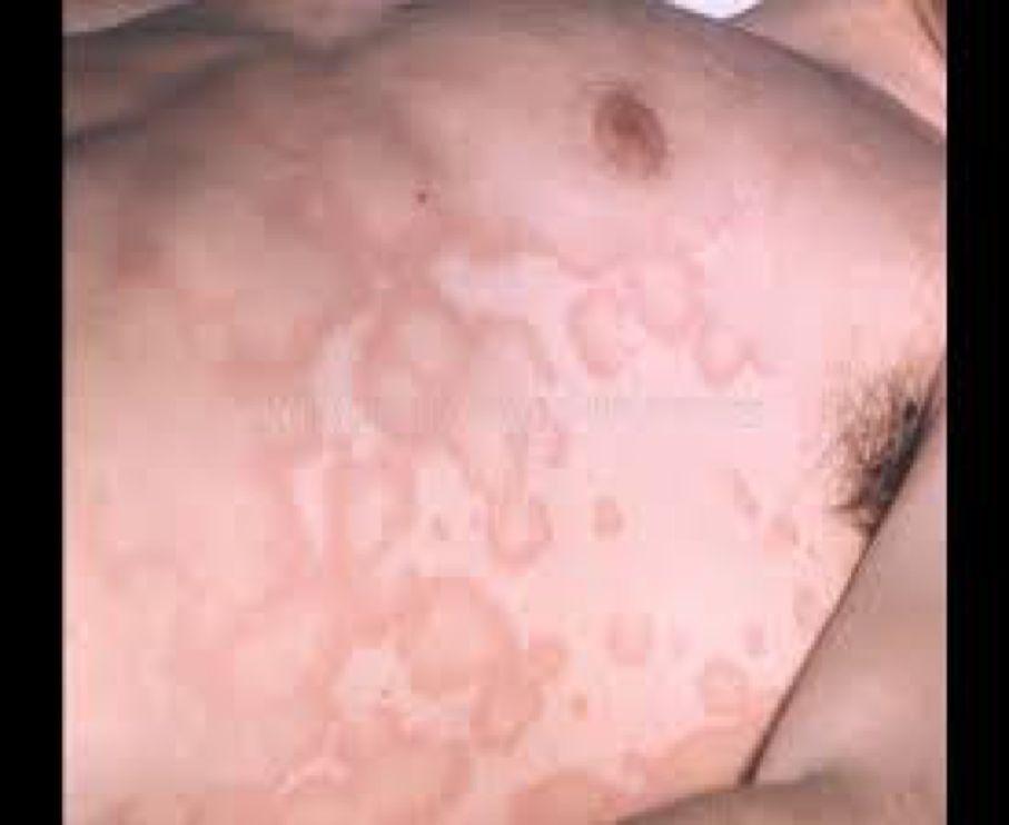 5-Erythema Marginatum: Very few will have this Erythema marginatum occurs in less than 6% of patients The lesions start as red macules that fade in the centre(pale center) but remain red at the