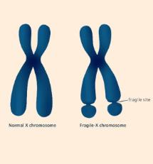Fragile X Fragile X gene (FMR1) is located on the X chromosome at Xq27.