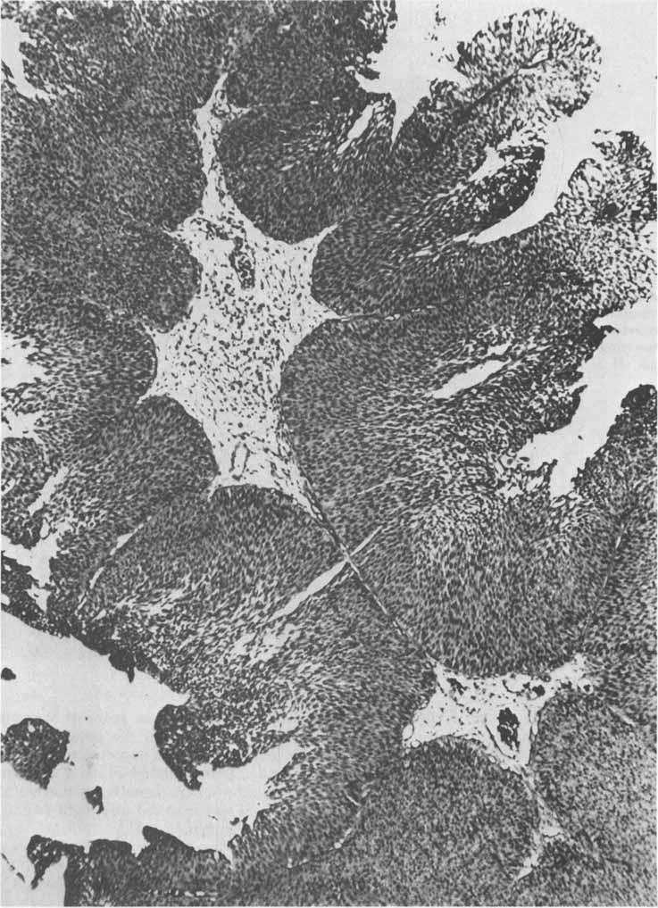 CANCER October 1978. Vol. 42 FIG. 2. Area of tumor showing papillary transitional cell carcinoma (H & E, X35). protein. The culture showed no growth.