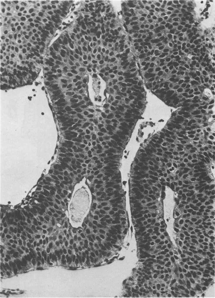 Vol. 49 INVERTED UROTHELIAL PAPILLOMAS. Lazarevic and Garret 1907 FIG. 3. Detail of typical anastomosing epithelial cords of inverted papilloma, with spaces containing proteinaceous material.