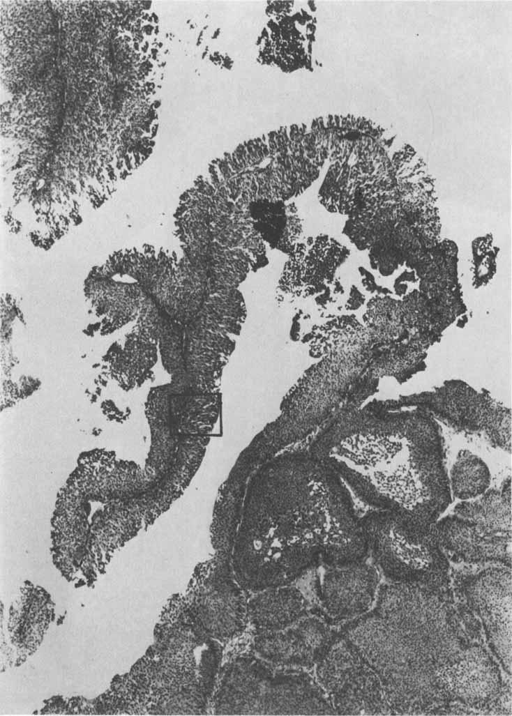 1908 CANCER October 1978 Vol. 42 FIG. 4. Papillary transitional cell carcinoma growing from the surface of inverted papilloma (H & E, X25).