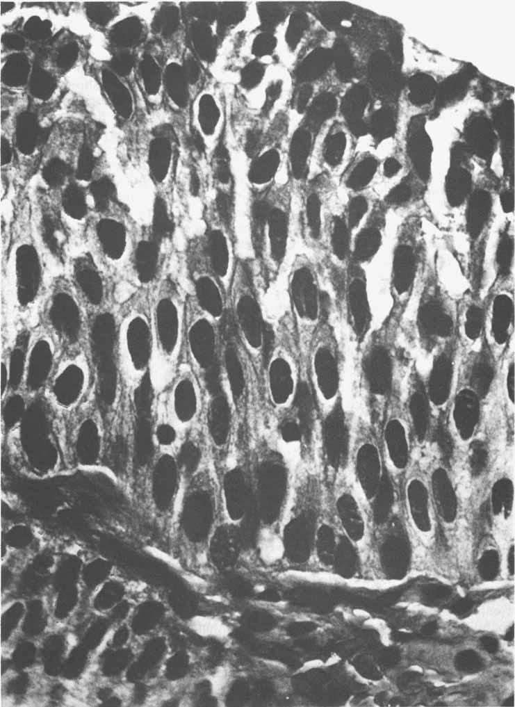 No. 4 INVERTED UROTHELIAL PAPILLOMAS * Lazarevic and Garret 1909 FIG. 5. Detail of papillary carcinoma from figure 4.
