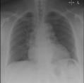 chest from radiographs Guy & were St Thomas detected