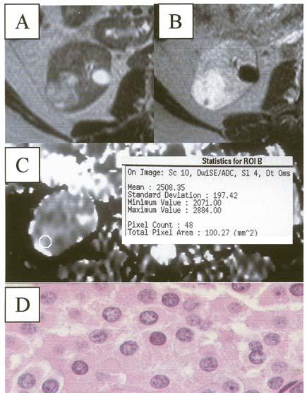 and histological specimen (D). Figure 3. Granular cell renal carcinoma.