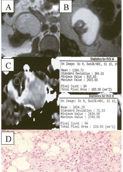 (C) and histological specimen (D). Figure 5. Angiomyolipoma.