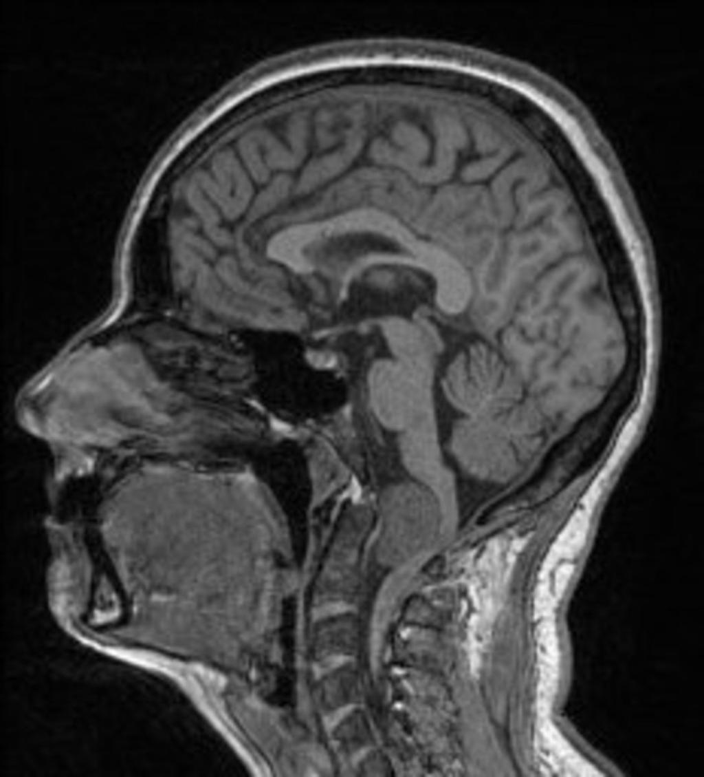 Fig. 5: Sagittal T1-WI shows a meningioma of the cervicocranial