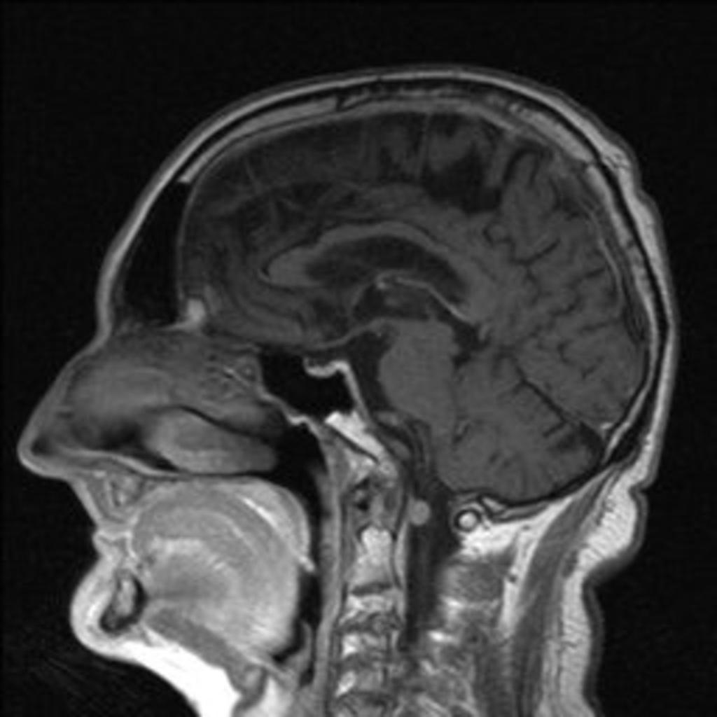 Fig. 9: Sagittal contrast-enhanced T1-WI shows a small