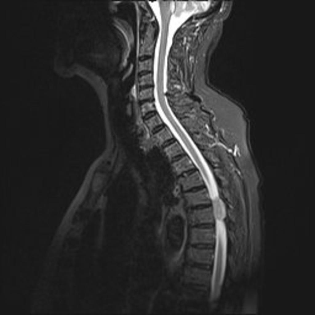 Fig. 13: Sagittal T2-WI shows a thoracic spine meningioma