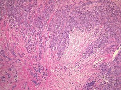 (15) This type of IDC is consisted to have undergone infarction at the center, and deposits of hyaline material and collagen occupy more than one-third of the cut surface of the tumor with sparse