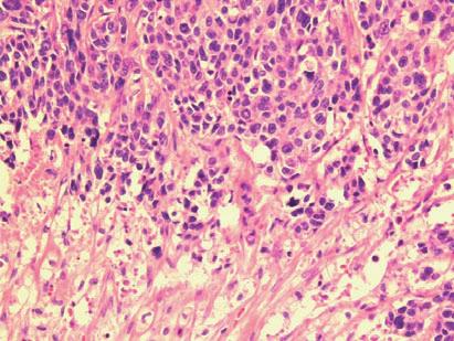 Recently, the presence of a CAZ has been noted in basal-like-type breast cancer.