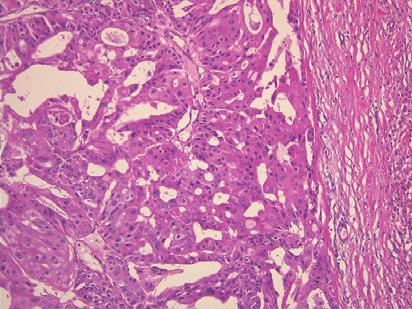 Apocrine carcinoma (type D), low-power view, HE stain): tumor cells with apocrine differentiation. Table 3.