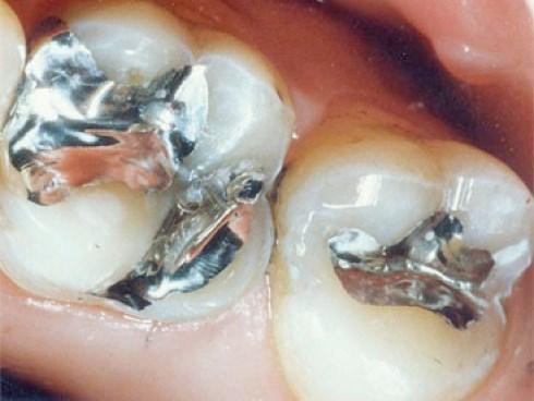 estetskih pomanjkljivosti je srebrna barva (Slika 7), ki se ne ujema s strukturo zoba.