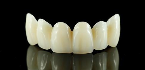 1.7.5 Keramika Zobna keramika (Slika 10) ostaja najboljši material, ki se ujema z estetiko zoba. Izdelana je iz anorganskih snovi, ki niso kovine.