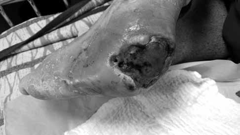 Sl. 4. Dekubitalna ulceracija nakon NPWT-a. Vlažna nekroza granulacija sa crvenilom okolne kože i deskvamacijom epitela ljepljivom oblogom. U rupičastim dijelovima rane ličinke.